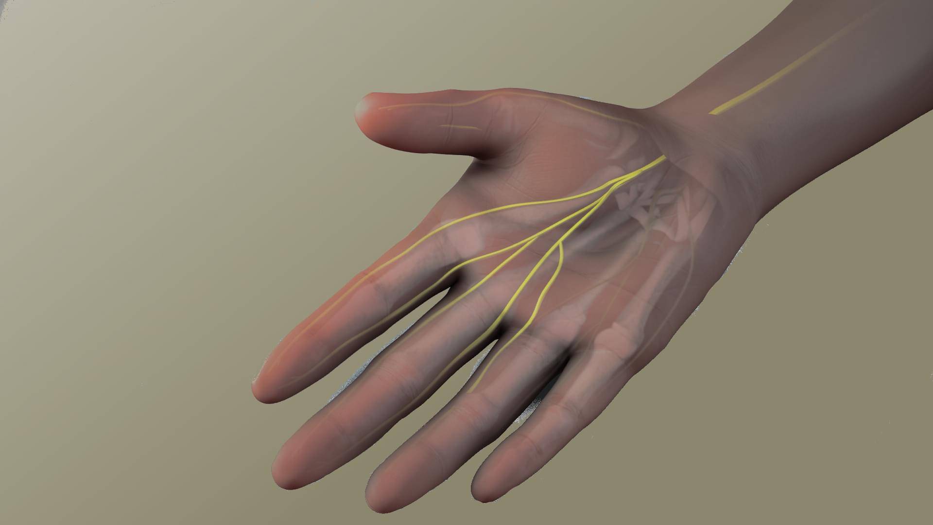 Syndr ome du Canal carpien Dr. Vytautas Gasiunas